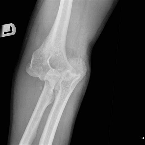 Elbow Fractures Fractures Fracture Dislocation Disloc