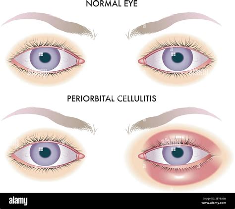 Cellulitis Eye Hi Res Stock Photography And Images Alamy