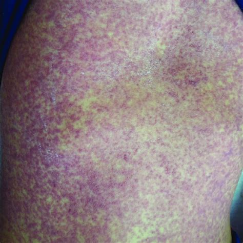 Multiple Erythematous Maculopapular Rashes With Excoriation Present