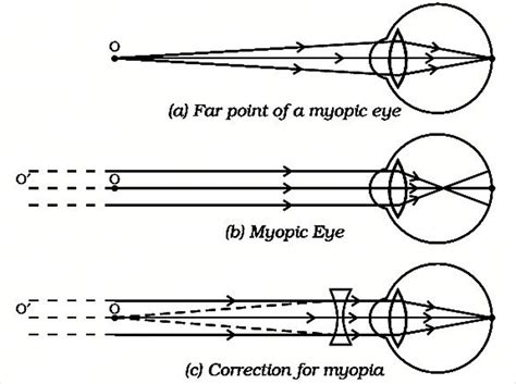 Contact lenses correct most vision problems 1, including: when do we consider a person to be myopic or hypermetropic ...