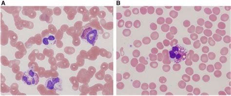 Eosinophils In Peripheral Blood Smear Peripheral Blood Eosinophils