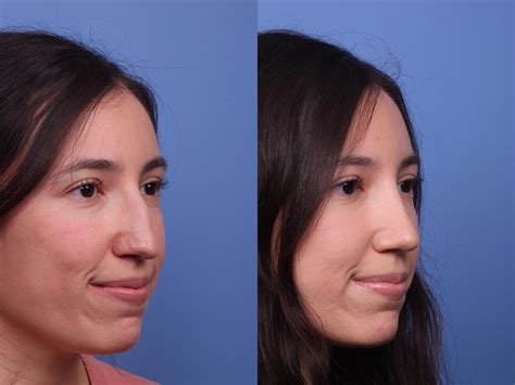 Rhinoplasty Before And After Pictures Case 383 Scottsdale Az