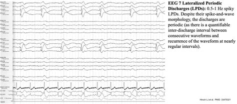 Normal Versus Abnormal Eeg