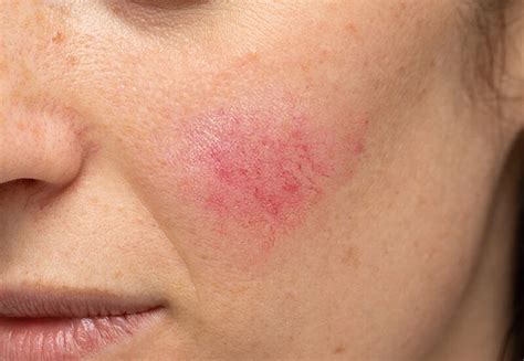 Red Alert Understanding And Treating Rosacea Slmd Skincare By Sandra