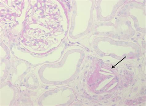 Renal Allograft Biopsy Of Patient Shows Cholesterol Crystals Arrow