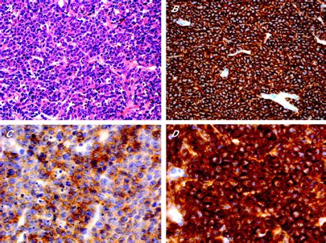 Cd5 Positive Diffuse Large B Cell Lymphoma Arising From A Cd5 Positive