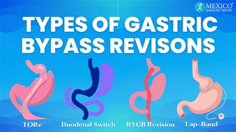 Types Of Gastric Bypass Revisions Mexico Bariatric Center