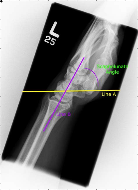 SCAPHOLUNATE LIGAMENT DISRUPTION Sport Med Babe