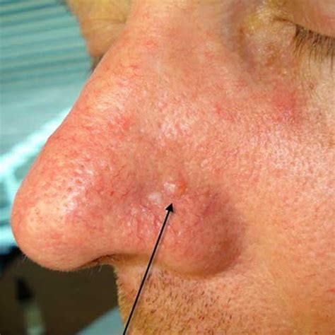 Early Stage Basal Cell Carcinoma Nose Pictures Braun Free Glider