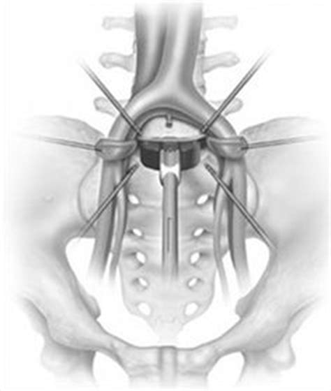This happens when the spongy area between the vertebrae starts to break down and the vertebrae. Pain from Degenerative Disc Disease | Back pain, Protein ...