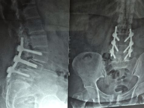 16 Surgical Internal Fixation Of Spine For Spondylolistheses