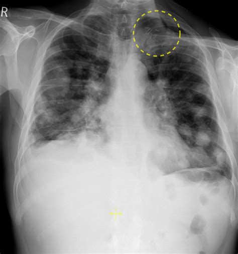 Lung Metastases From Head And Neck Cancer Radiology At St Vincent S