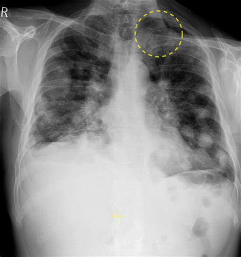 The doctor will look at the entire inside of your mouth, and might feel around in it with a gloved finger. Lung metastases from head and neck cancer - Radiology at ...