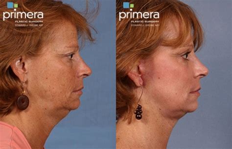 Mini Facelift Before And After Pictures Case 106 Orlando Florida Primera Plastic Surgery