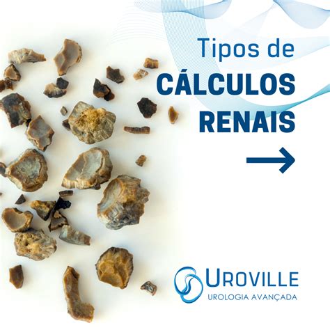 Calculo Renal Da Febre