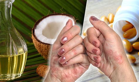 Coconut oil is considered to be healthy, owing to its diverse therapeutic properties. Eczema treatment: Prevent dry, itchy skin with coconut oil ...