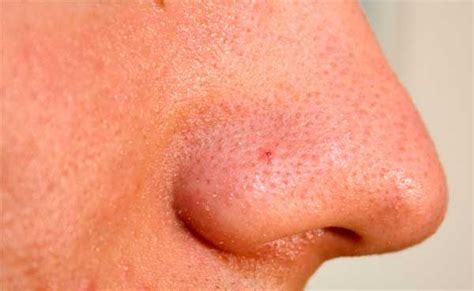 How To Shrink Pores On Nose 8 Best Home Remedies For Open Pores