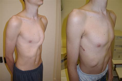 Specialists with the utah pectus program see between 100 and 150 people each year who have pectus carinatum. Initial results with minimally invasive repair of pectus ...