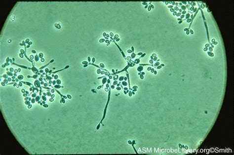 Authoritative facts from dermnet new zealand. Sporothrix Schenckii --etiologic agent of Sporotrichosis ...