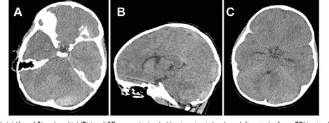 Figure 1 From Occipital Aneurysmal Bone Cyst Rupture Following Head