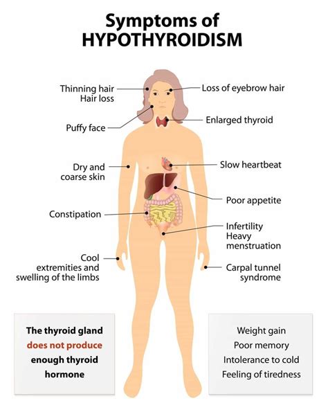 Tsh With Reflex With Images Hypothyroidism Symptoms Thyroid