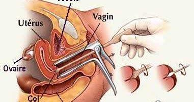 A pap smear, also called a pap test, is a screening performed in your doctor's office (typically by a gynecologist, but nurse practitioners and family doctors also perform them). small girl with a big heart: Wanita2/Ibu2 jangan lupa ...