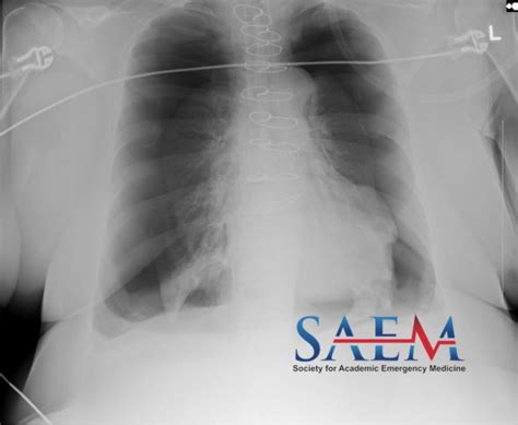 Saem Clinical Image Series Shortness Of Breath