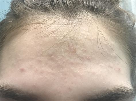 Skin Concern What Are All These Tiny Bumps Called And How Can I Get
