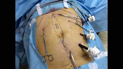 Laparoscopic Ventral Hernia Repair Easy Bridging Metin Ertem Md Facs