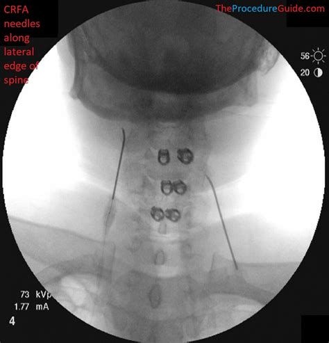 Cervical Medial Branch Block And Radiofrequency Ablation Oblique The