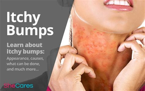 Small Red Itchy Bumps On The Skin Are A Common Presentation Of