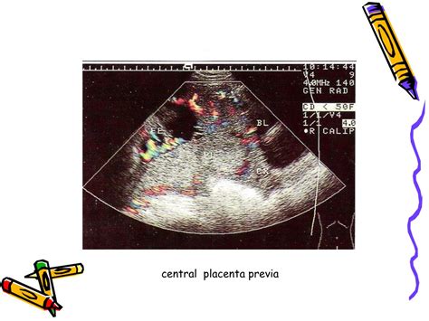 PPT Placenta Previa Placental Abruption PowerPoint Presentation Free