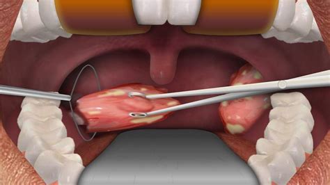 Tonsillectomy Procedure Step By Step