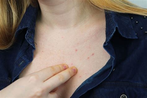 How To Get Rid Of Chest Acne Maeves All Natural