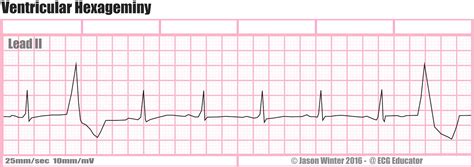 Ecg Educator Blog Ventricular Ectopics