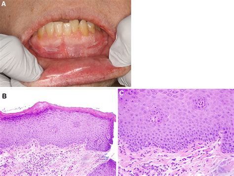 Hyperkeratosis Not Reactive A Demarcated Fissured Leukoplakia Of The