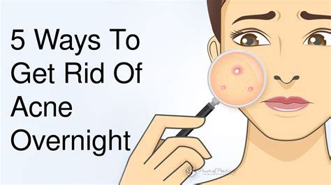 5 Ways To Get Rid Of Acne Overnight Diy Acne Treatment Acne