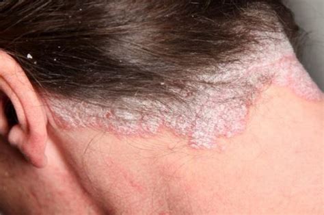Itchy Eyebrows Forehead And Scalp How To Get Rid Of Pimples On Scalp