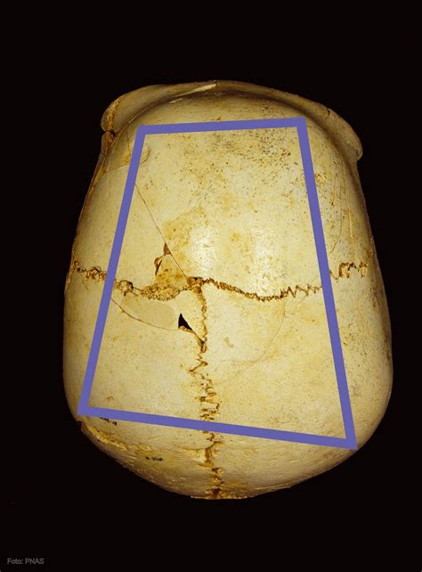 El Cráneo 14 De La Sima De Los Huesos De Atapuerca Apodado Benjamín