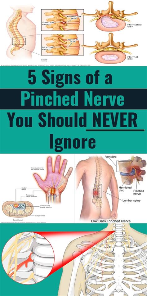 Signs Of A Pinched Nerve You Shouldnt Ignore Pinched Nerve Nerve
