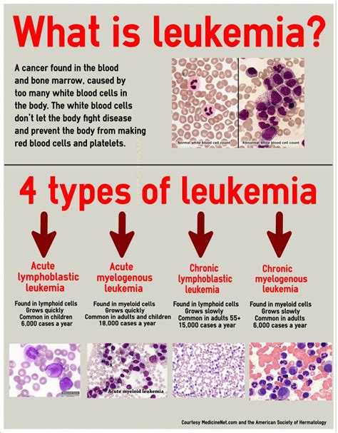 Understanding Acute Lymphocytic Leukemia Causes Patho