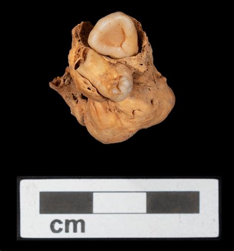 Oldest Archaeological Teratoma Found In New Kingdom Burial The History Blog