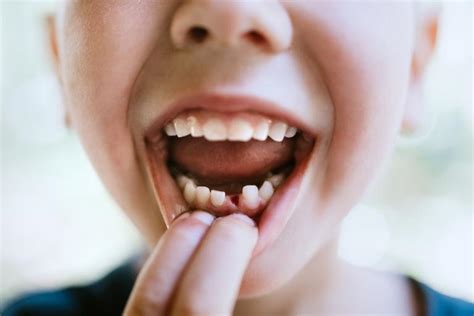 What Happens When Your Baby Teeth Fall Out Too Early Carifree