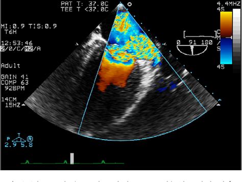 Figure 2 From Successful Mitral Valve Repair For Severe Mitral