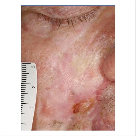 The Patient Presented With A Recurrent Basal Cell Carcinoma Of The