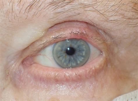 Explaining Eyelid Reconstruction Following Skin Cancer Removal Focus