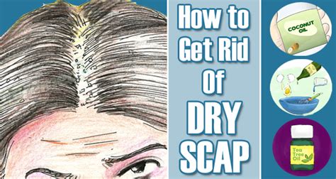 How To Get Rid Of Dry Scalp Overnight With Home Remedies Dry Scalp