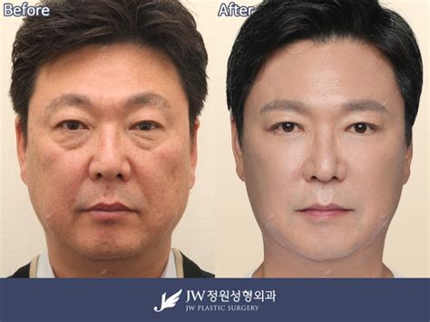 Non Incision Undereye Surgery In Seoul Korea Jw Clinic