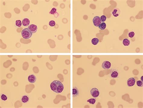 Lymphoplasmacytoid Cytology In Plasma Cell Leukemia Khoder 2018