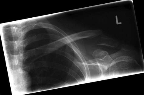 Lateral Clavicle Fracture Neer Type Ii Of A 45 Year Old Male Patient